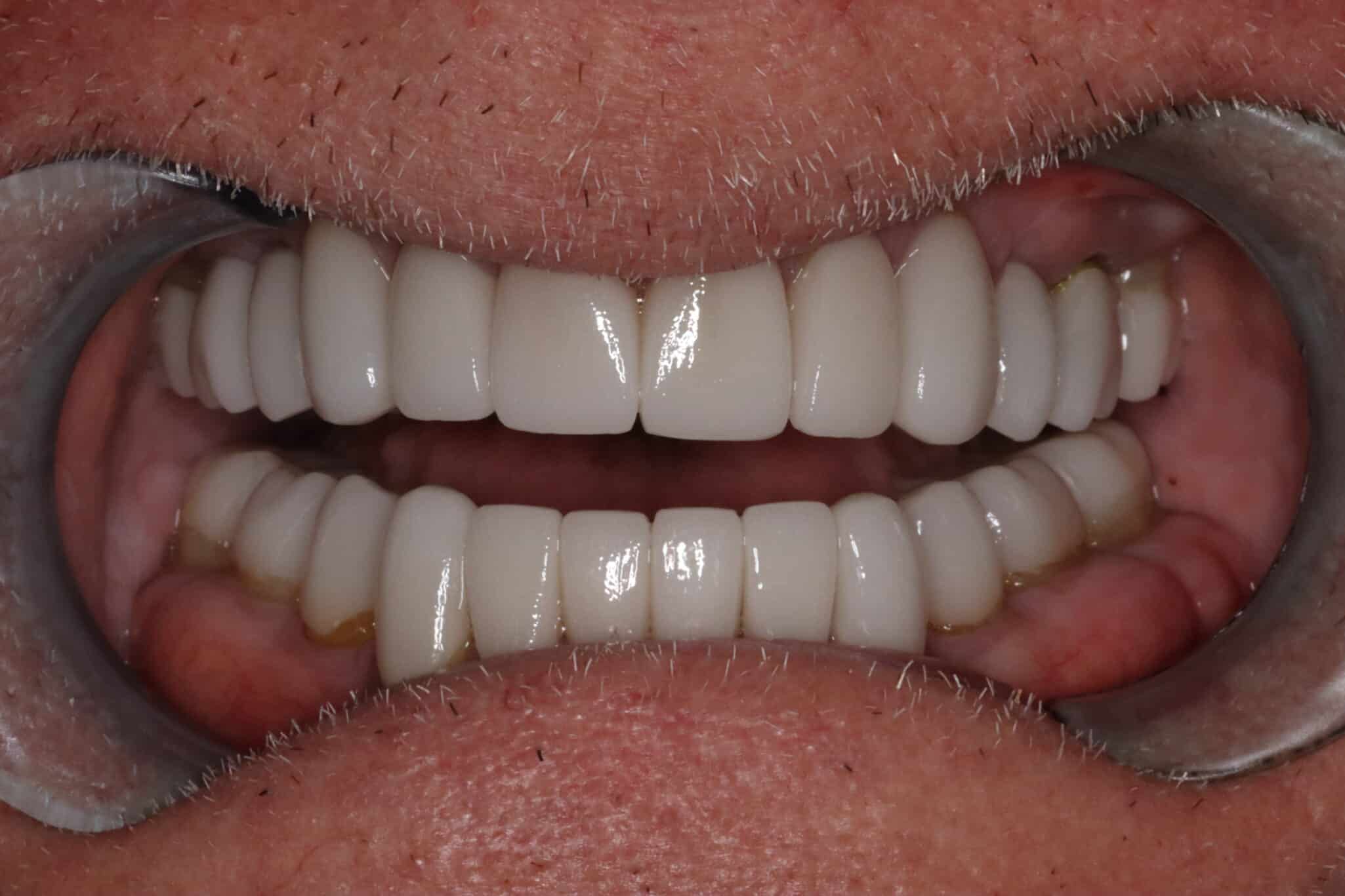 set of teeth, straight and white after smile makeover