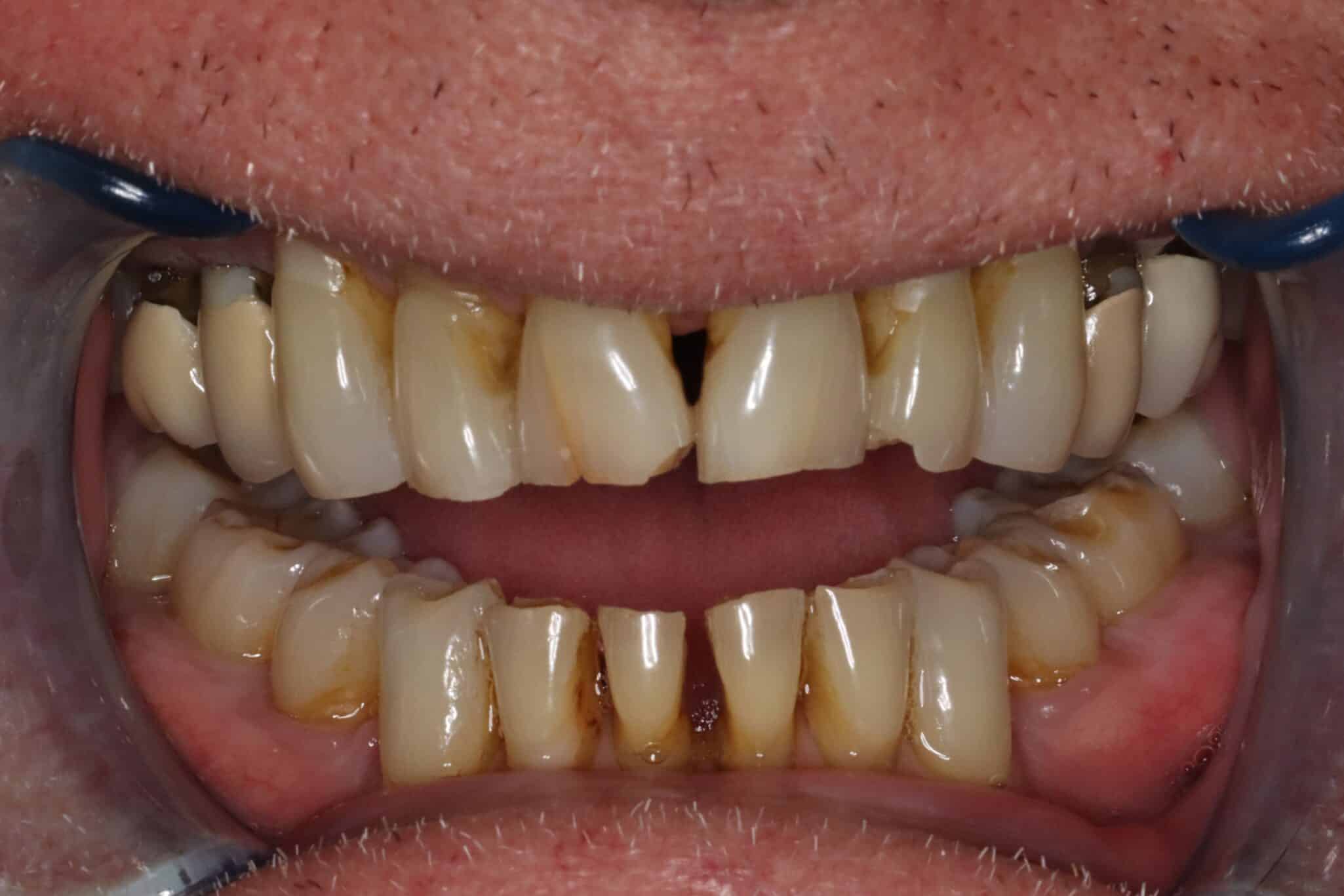 set of teeth, brown and cracked, before smile makeover