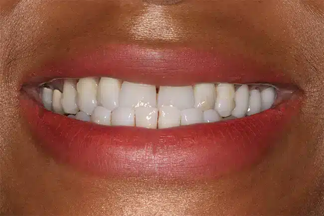 66214 underbite b1.jpg (1)