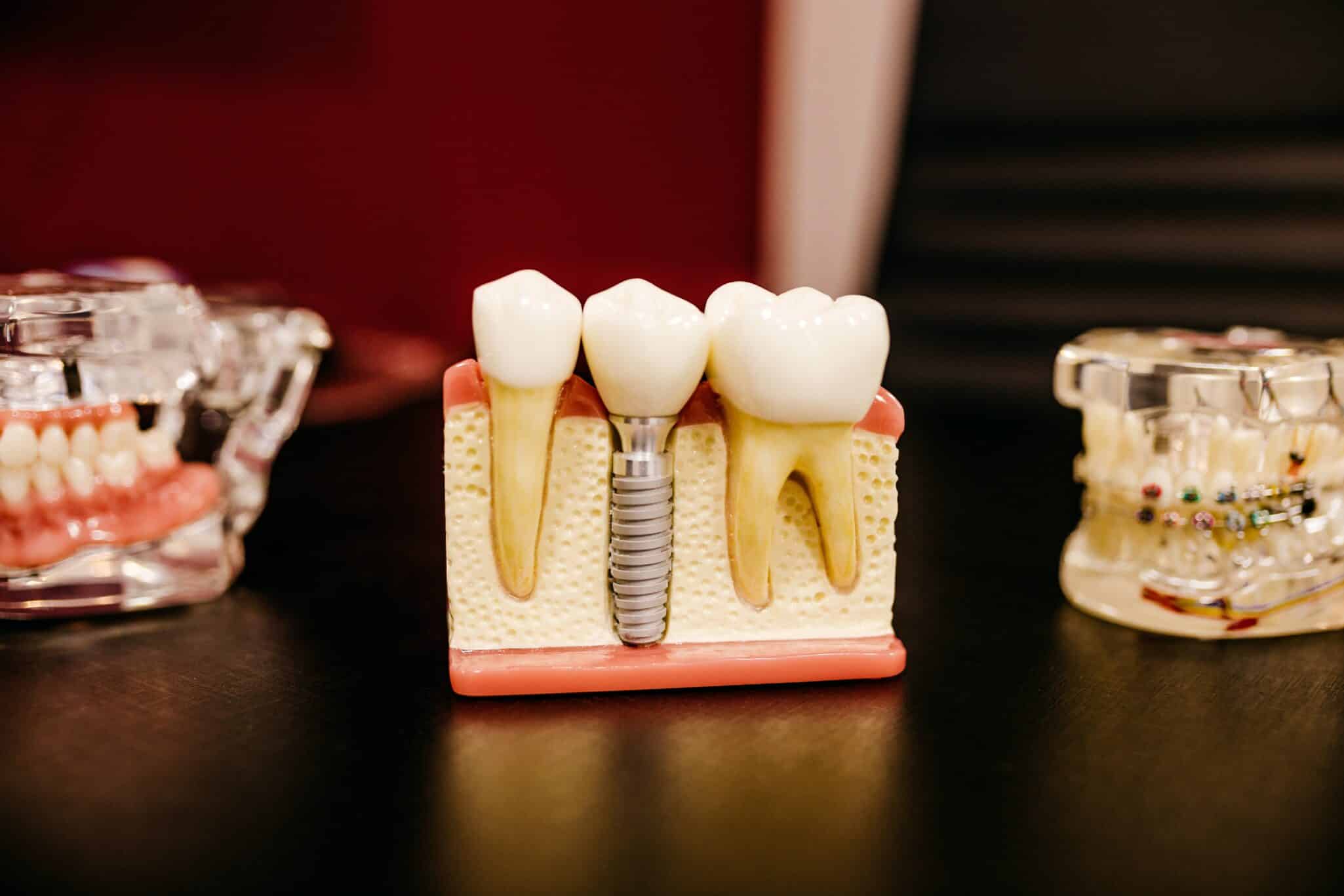 A dental model showing the benefits of dental implants.