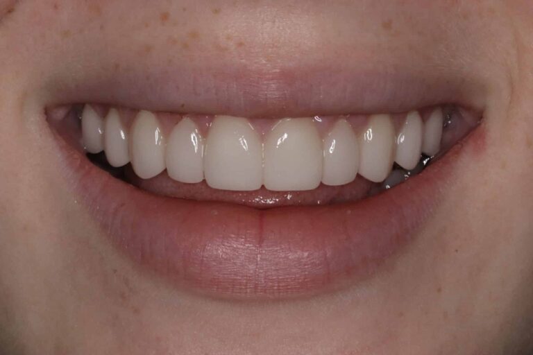 After Image: Minimal Prep Veneers to Create a Beautiful Smile - front