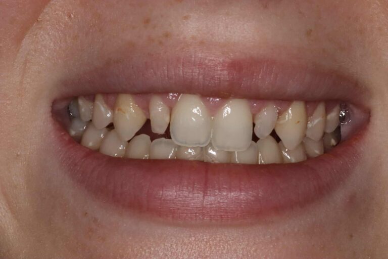 Before Image: Minimal Prep Veneers to Create a Beautiful Smile - front