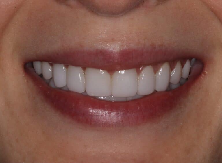 After Image: Minimal Prep Porcelain Veneers - front