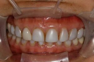 Porcelain Veneer Overbite Case