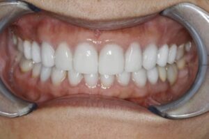 Porcelain Veneer Overbite Case