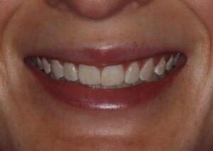 Minimal Prep Porcelain Veneers