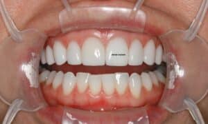 implant crown and veneers