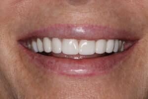 Can I Create a Fuller Smile As I Have Worn Teeth?