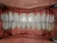 dental implant2
