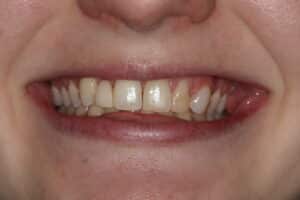 Comprehensive Cosmetic Smile Design