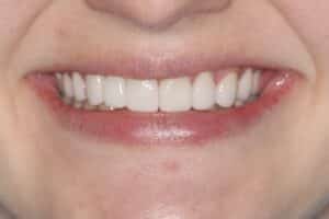 Comprehensive Cosmetic Smile Design