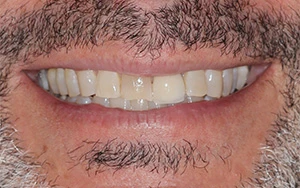 Before: Broken, discolored, and worn front teeth