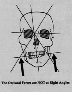 cranial derangement
