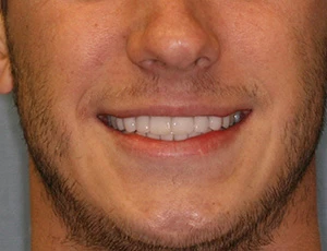 Man smiling showing straight white teeth after veneers