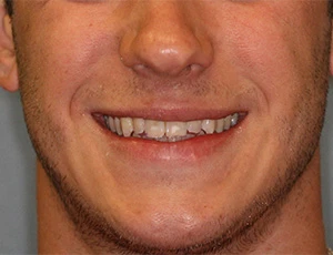 Man smiling showing uneven teeth before dental veneers