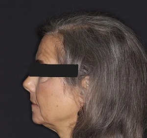 Side profile of woman after overbite correction with improved jawline definition
