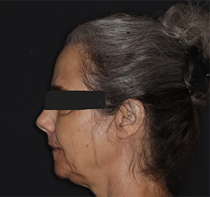 Side profile of woman with an overbite jawline before treatment