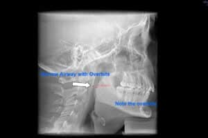 Before: overbite causing constricted airway