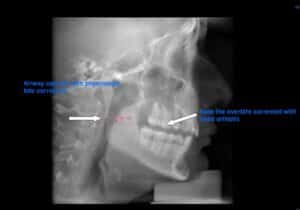 After: non-surgical overbite correction