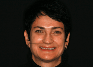 Before: overbite weak chin, TMJ pain, facial symmetry