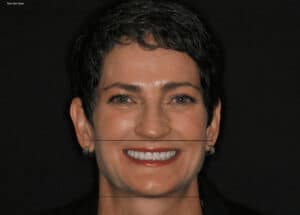 After: Non-surgical bite correction