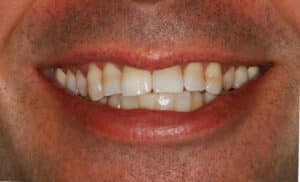Before: TMJ pain, headaches, worn teeth