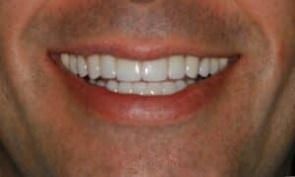 After: Non-surgical jaw alignment, no TMJ pain, esthetic smile