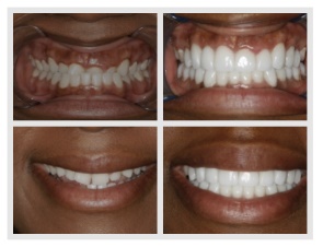 Before and after non-surgical overbite correction