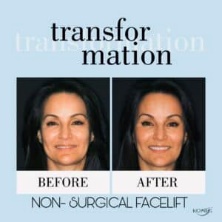 Misaligned bite, facial asymmetry, overbite corrected non-surgically