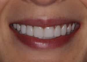 After: No-prep veneers utilized to broaden the smile