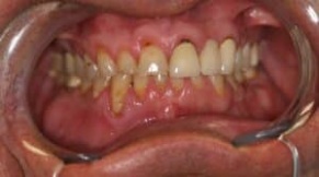 Damage from bruxism