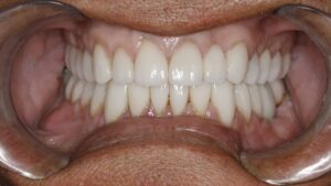 Bite correction for bruxism