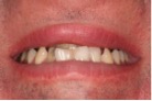 Crooked and worn teeth