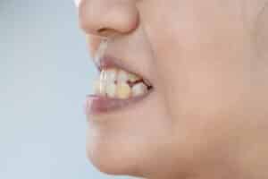 Underbite treatment options