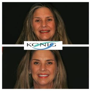 facial asymetry