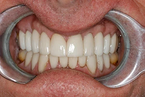 healthy white teeth after treatment