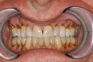 receding discolored gums before treatment