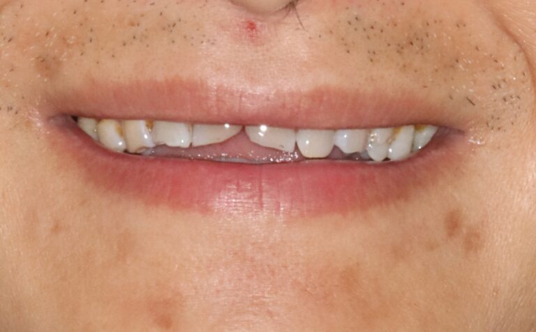 TMJ Disorder Is Not Always Just About Pain