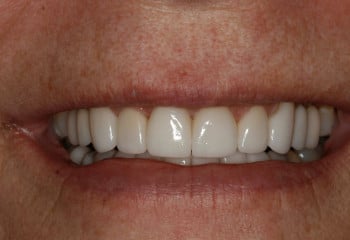 A Case Designed to Correct Small Teeth and Tetracycline Stains