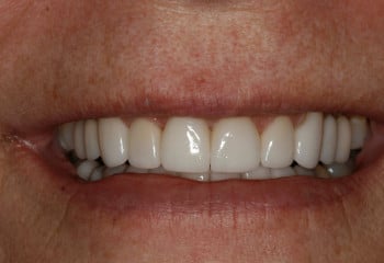 After Image: A Case Designed to Correct Small Teeth and Tetracycline Stains - front