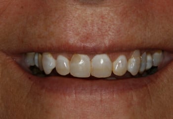 Before Image: A Case Designed to Correct Small Teeth and Tetracycline Stains - front