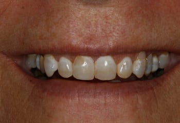 A Case Designed to Correct Small Teeth and Tetracycline Stains