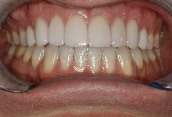 After Image: Advanced Porcelain Veneer Designs, Bite Correction, Life Changing Smile!! - front