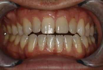 Before Image: Advanced Porcelain Veneer Designs, Bite Correction, Life Changing Smile!! - front
