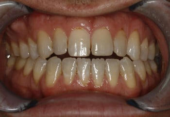 Advanced Porcelain Veneer Designs, Bite Correction, Life Changing Smile!!