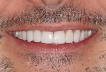 After Image: Broken and Worn Teeth: A Beautiful New Smile With Custom Porcelain Veneers - front