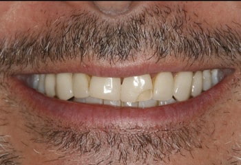 Broken and Worn Teeth: A Beautiful New Smile With Custom Porcelain Veneers
