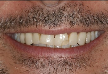 Before Image: Broken and Worn Teeth: A Beautiful New Smile With Custom Porcelain Veneers - front